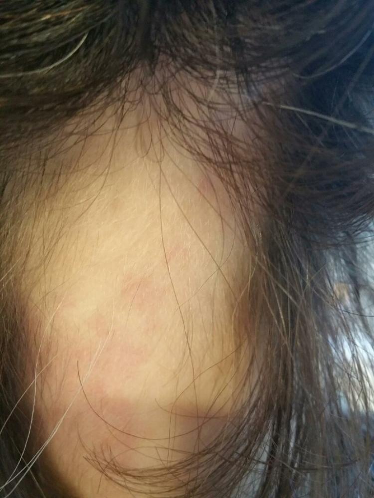 My Alopecia Story | Healthful Elements