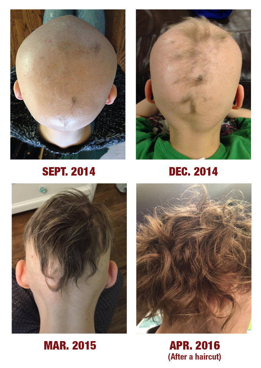 From Total Hair Loss To A Head Of Curls Healthful Elements